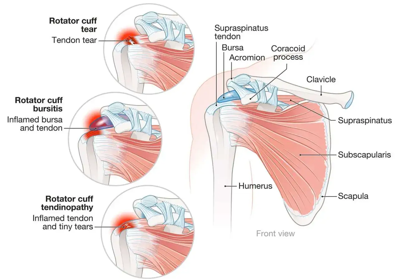 Ilustracja przedstawia naciągnięty bark z zaznaczonymi urazami: naderwaniem ścięgna, zapaleniem kaletki i ścięgna oraz tendinopatią.